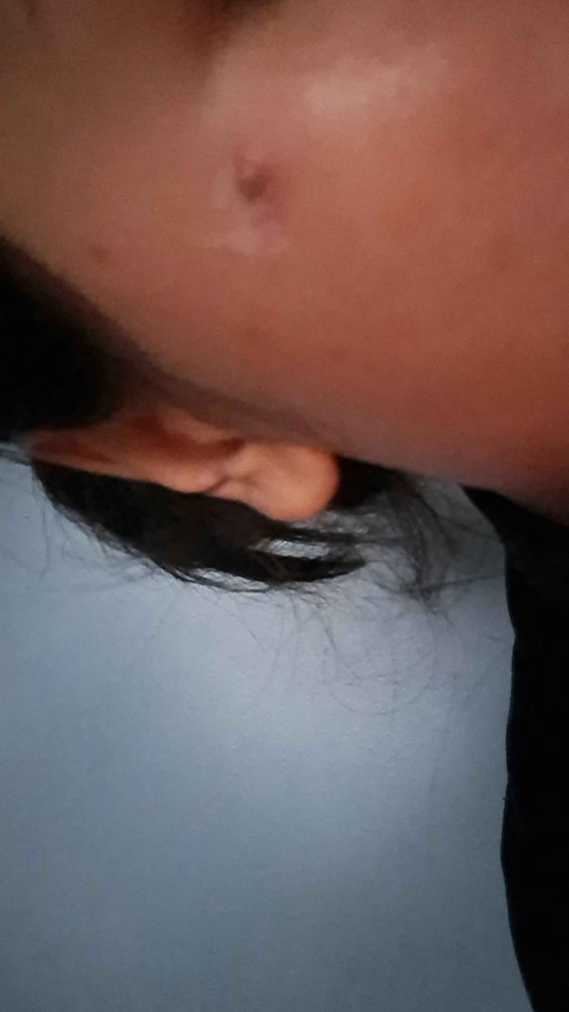 Customer photo review of Akne Karşıtı Losyon