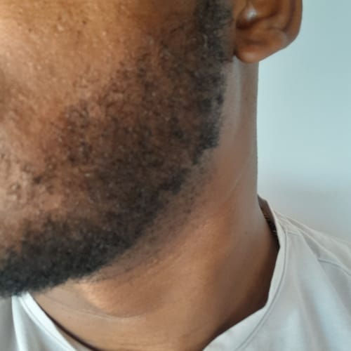 Customer photo review of Minoxidil High Strength (5%) SOLUTION, 3x60ml pack