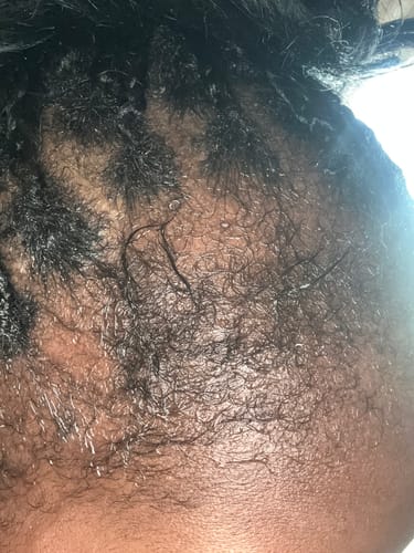 Customer photo review of Minoxidil REGULAR (2%) strength SOLUTION, 3x60ml pack