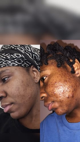 Customer photo review of Tea Tree Daily Face Wash/Cleanser