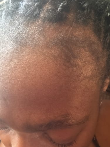 Customer photo review of Minoxidil High Strength (5%) SOLUTION, 3x60ml pack