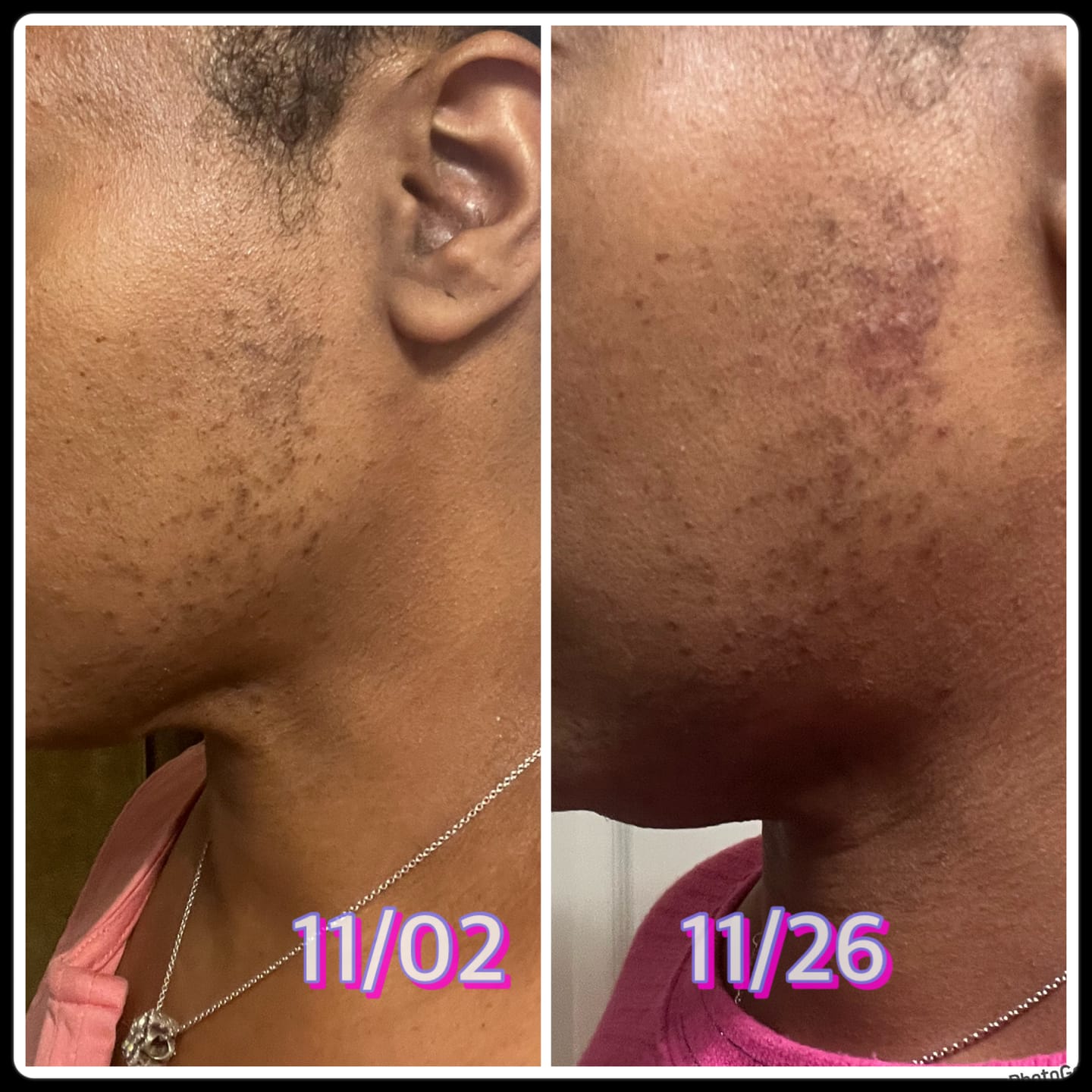 Customer photo review of Hair Reducing Fade Oil - Slows Growth, Thins, and Reduces Hair Naturally