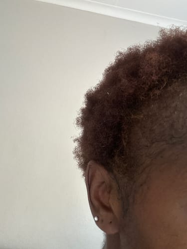 Customer photo review of Minoxidil 5% Solution, 1 Pack 60ml