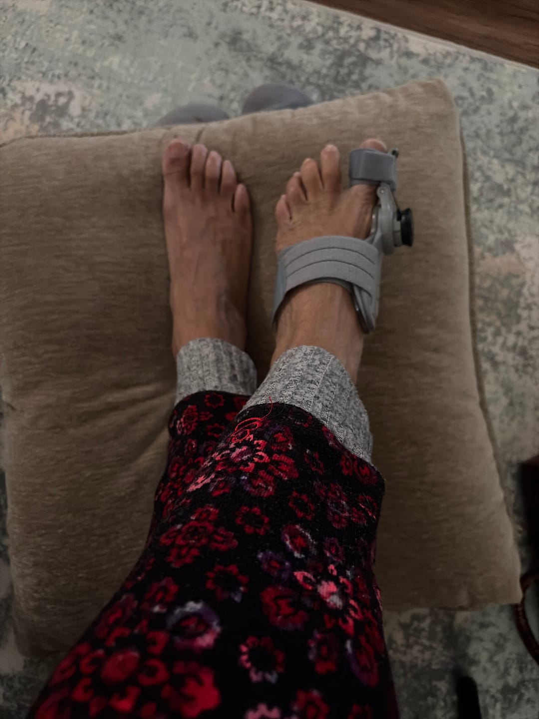 Customer photo review of Treatmedy™ Bunion Fix