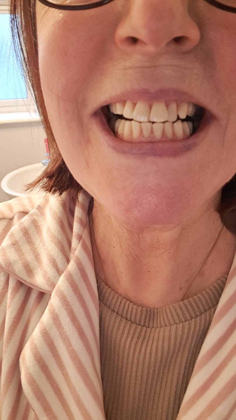 Customer photo review of Sensitive Teeth Whitening Toothpaste