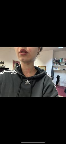 Customer shows a red rash on their neck, illustrating their skin condition before using the Multi Strain Biotic.