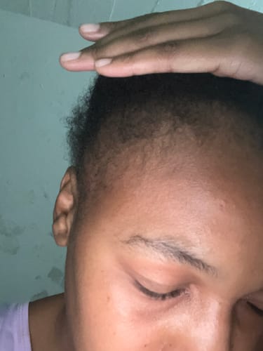 Customer photo review of Minoxidil High Strength (5%) FOAM, 3x60ml pack