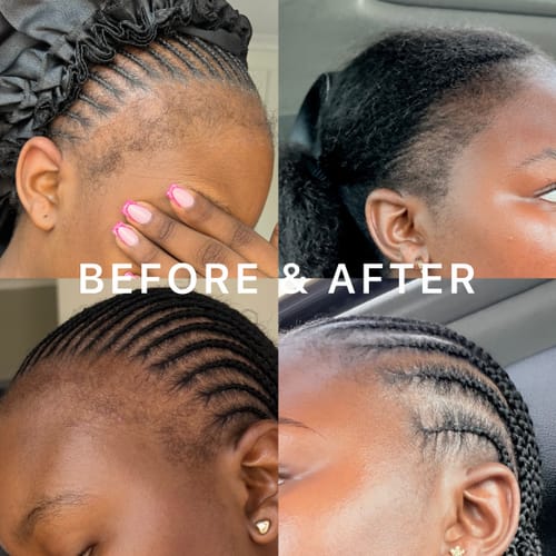 Customer photo review of Minoxidil High Strength (5%) SOLUTION, 3x60ml pack