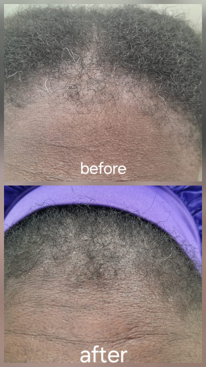 Customer photo review of Ultra-Fast Growth Oil for Thinning Hair