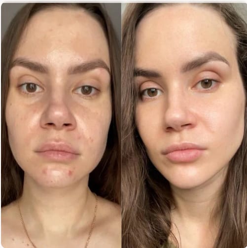 Customer photo review of LayaDerm - Retinal Shot