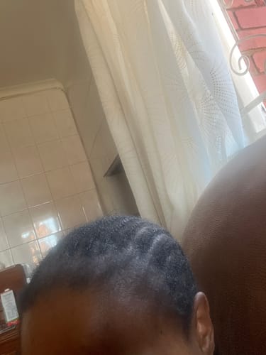 Customer photo review of Minoxidil 5% Solution, 1 Pack 60ml