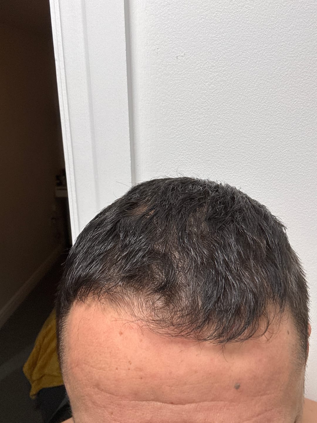 Customer photo review of High Strength Unisex LED Hair Growth Cap with Red Light & Deep Infrared Therapy