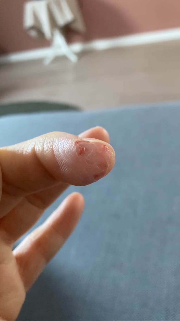 Customer photo review of The Potions Centella Asiatica Water Essens (20ml) - Helbredende og foryngende. Reduserer akne, psoriasis og eksem