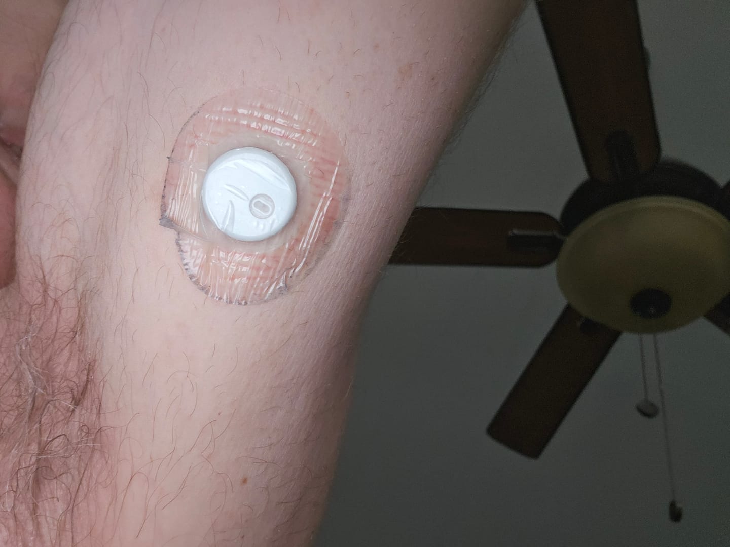 Customer photo review of Skin Grip Original - Libre 3+ Adhesive Patches