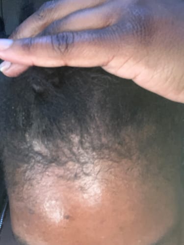 Customer photo review of Minoxidil 5% Solution, 1 Pack 60ml