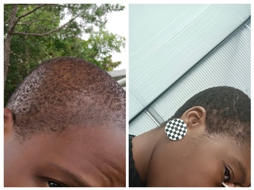 Customer photo review of Minoxidil REGULAR (2%) strength SOLUTION, 3x60ml pack