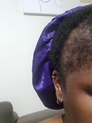 Customer photo review of Minoxidil High Strength (5%) SOLUTION, 3x60ml pack