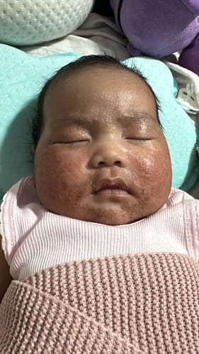 Customer's photo of a baby with a severe, inflamed rash on their face before using Hemp Seed Butter.