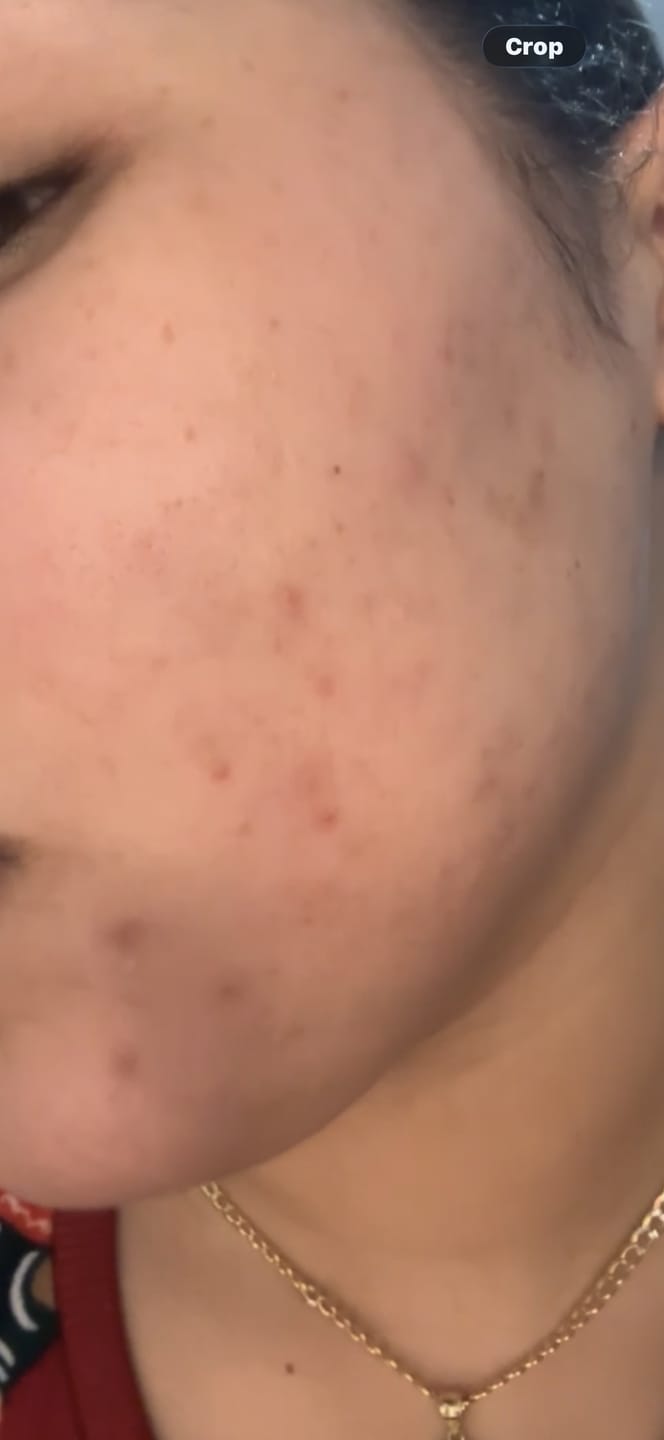 Customer photo review of Acne Drying Lotion Plus — 2 Pack (20 mL × 2)