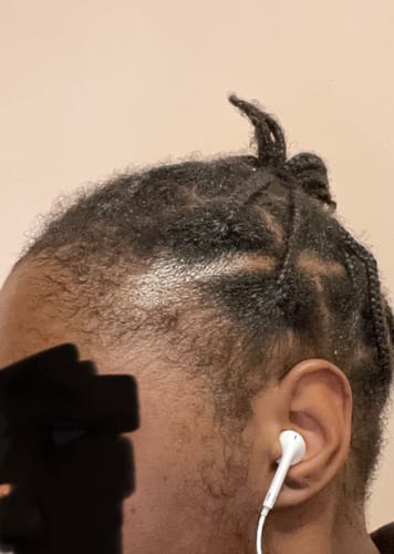 Customer photo review of Minoxidil DOUBLE ACTION Solution - MEN ONLY, 3x60ml pack