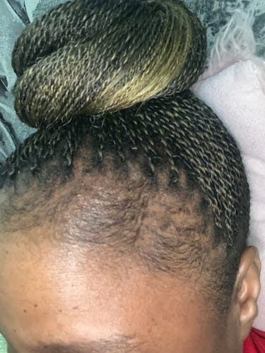 Customer photo review of Minoxidil High Strength (5%) SOLUTION, 3x60ml pack