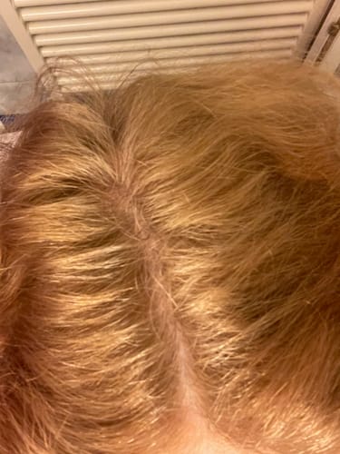 Customer's close-up photo of their scalp and hair after applying the Glov Hair Regrowth System.