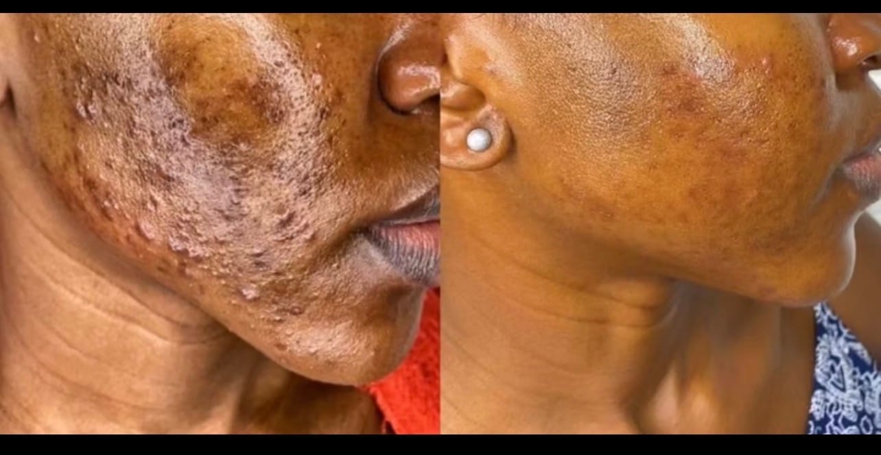 Customer photo review of 24k Golden Glow Essential Acne Kit
