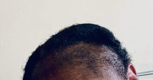 Customer photo review of Minoxidil High Strength (5%) FOAM, 3x60ml pack