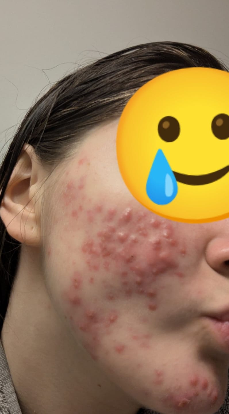 Customer photo review of Zyntra Hydrocolloid Roll