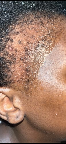 Customer photo review of Minoxidil 5% Solution, 1 Pack 60ml