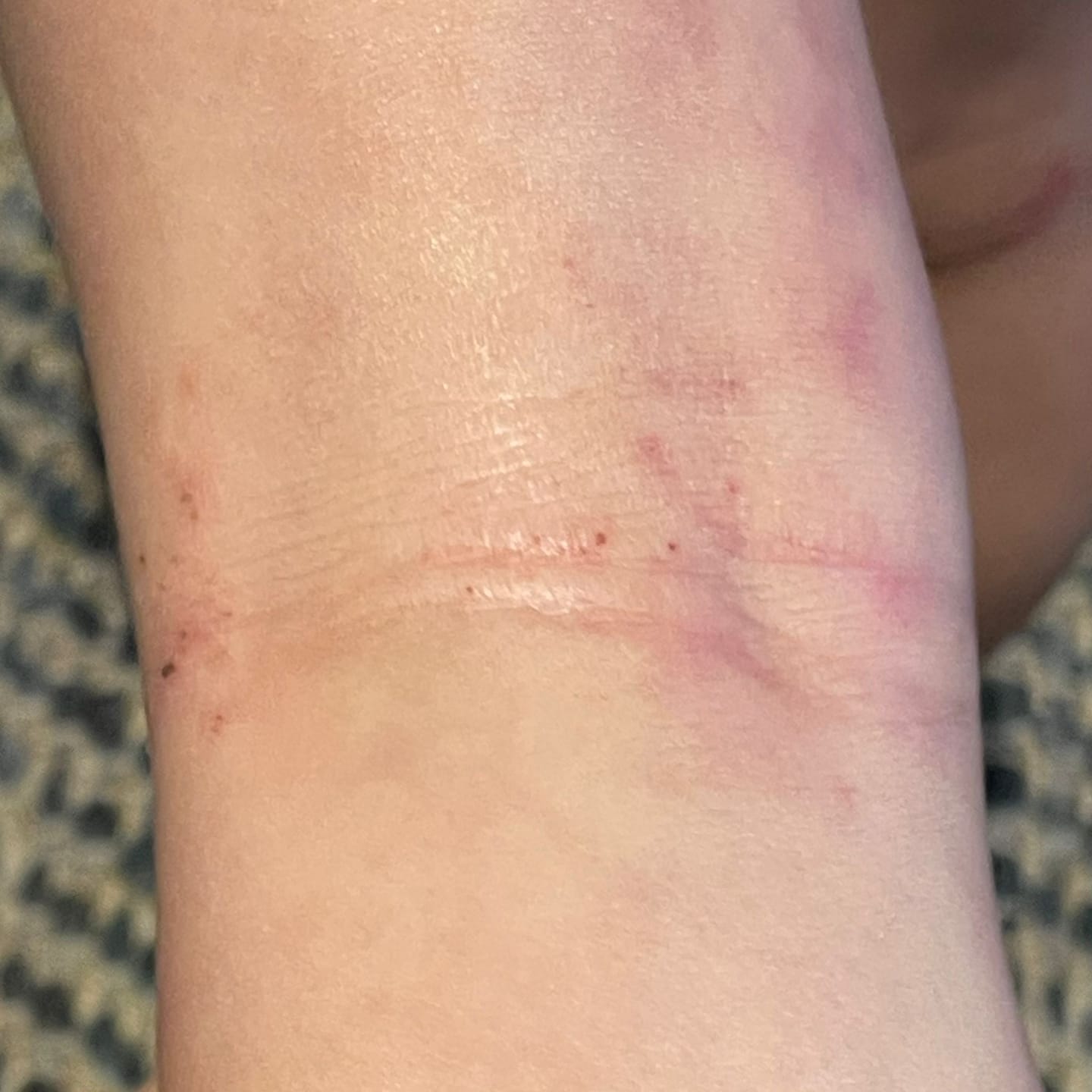 Customer photo review of Bioskin Junior Outbreak Rescue Cream