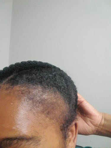 Customer photo review of Minoxidil High Strength (5%) FOAM, 3x60ml pack