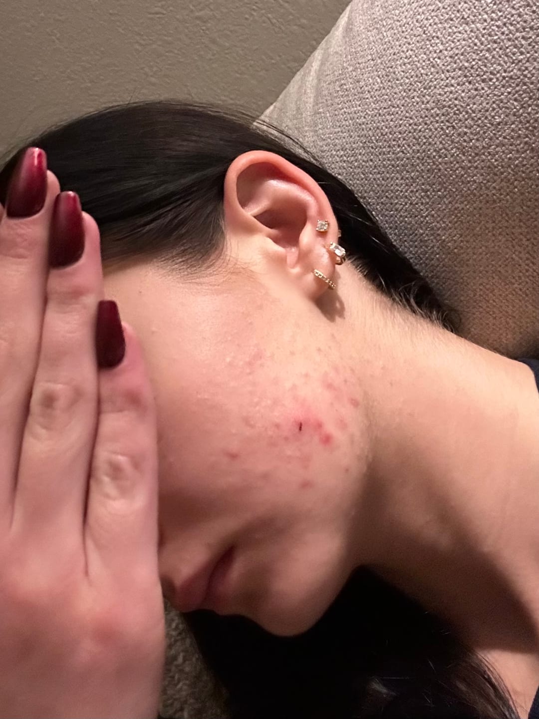 Customer photo review of Kill Acne & Redness Ritual