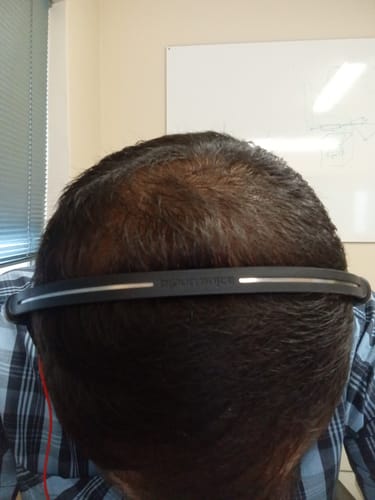 Customer photo review of Minoxidil DOUBLE ACTION Solution - MEN ONLY, 3x60ml pack