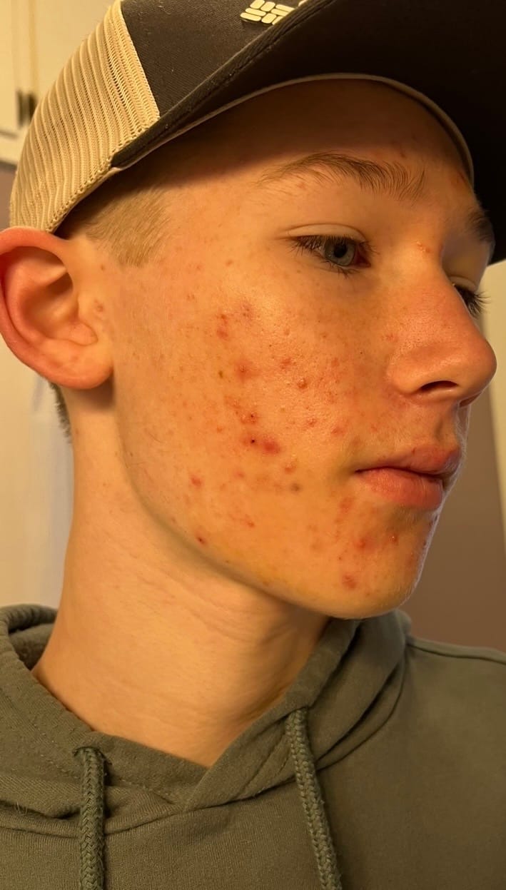 Customer photo review of Kill Acne & Redness Ritual