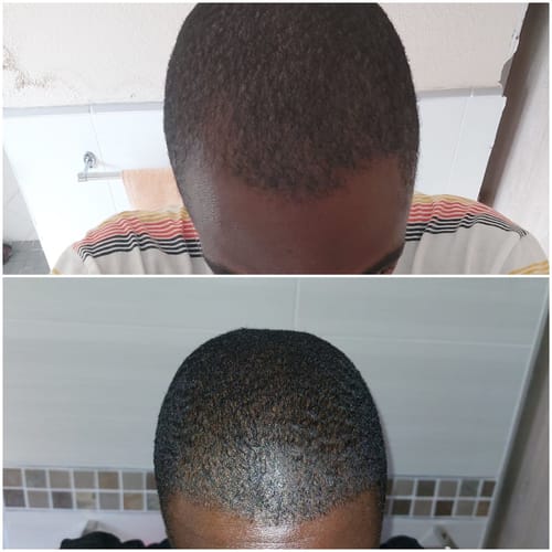 Customer photo review of Minoxidil 5% SOLUTION, 3x60ml pack
