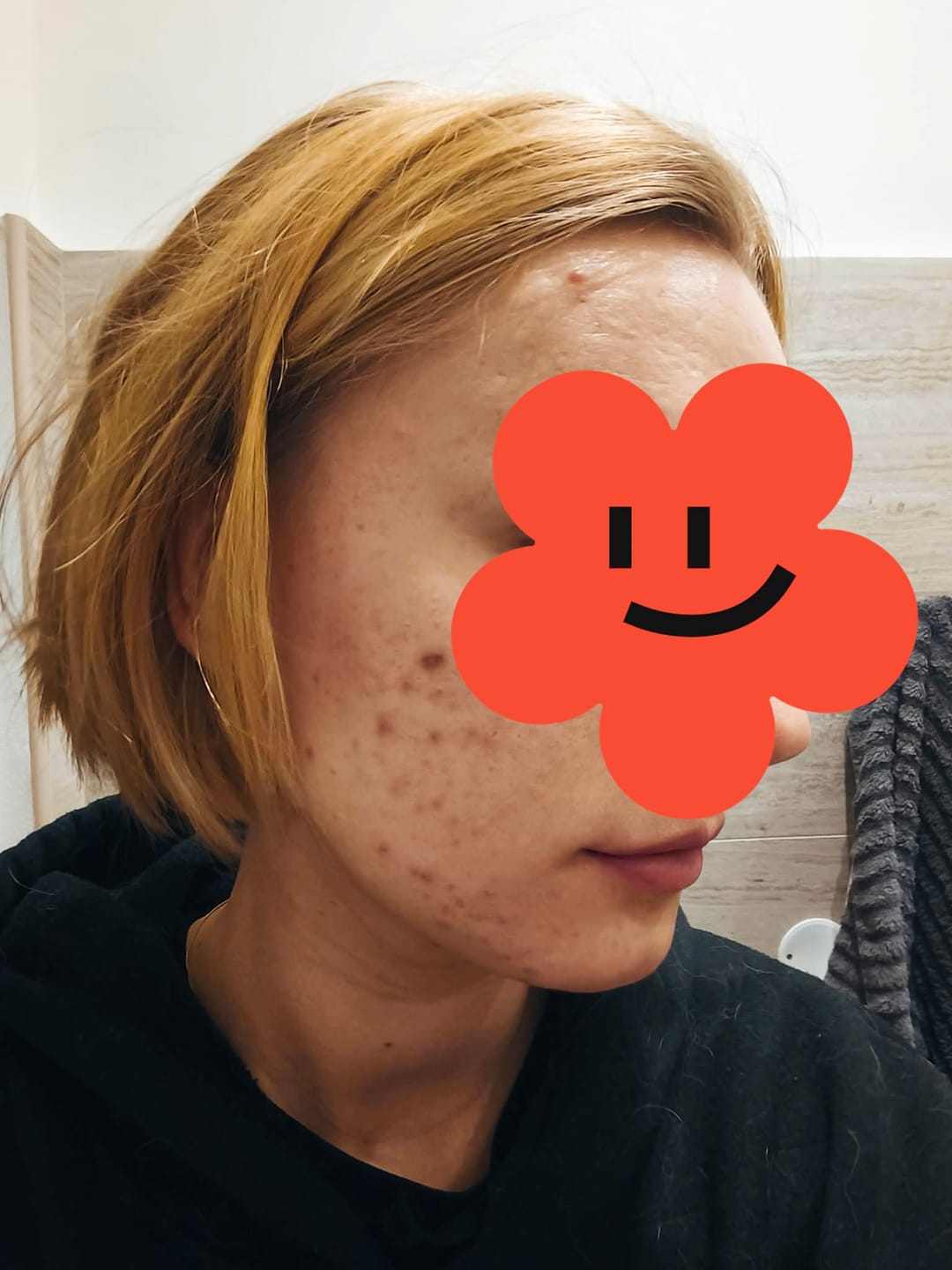 Customer photo review of Koanna® MultiGlo™ LED Light Therapy Mask