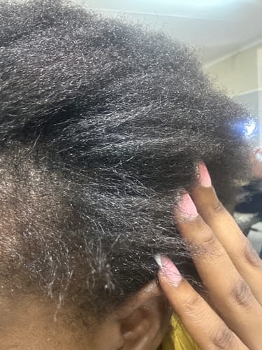 Customer photo review of Minoxidil REGULAR (2%) strength SOLUTION, 3x60ml pack