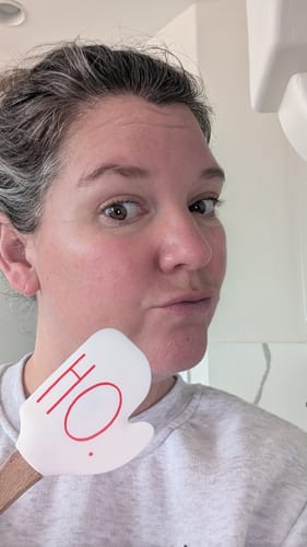 Reviewer showing their facial skin after using the Seranova Micro Infusion System.