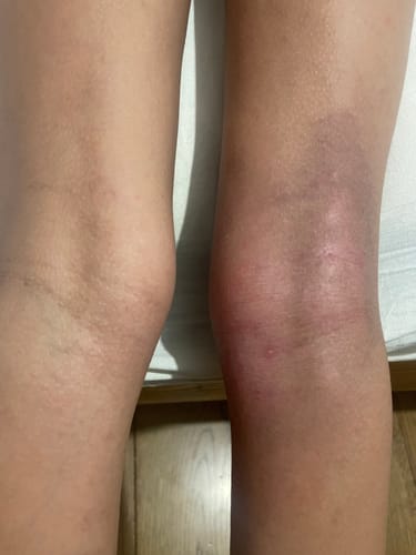 Customer's photo of a red, inflamed skin flare-up on the back of a knee, treated with Skin Saviour Balm.