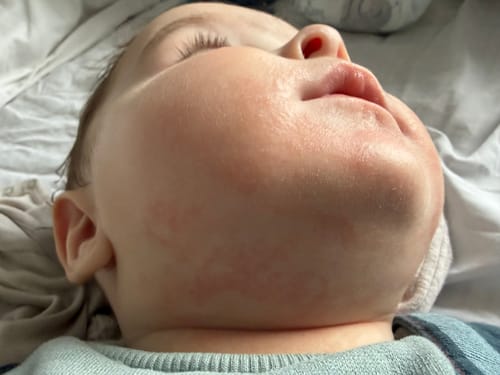 Close-up of a customer's baby with red, irritated skin on his cheeks and chin before using the product.