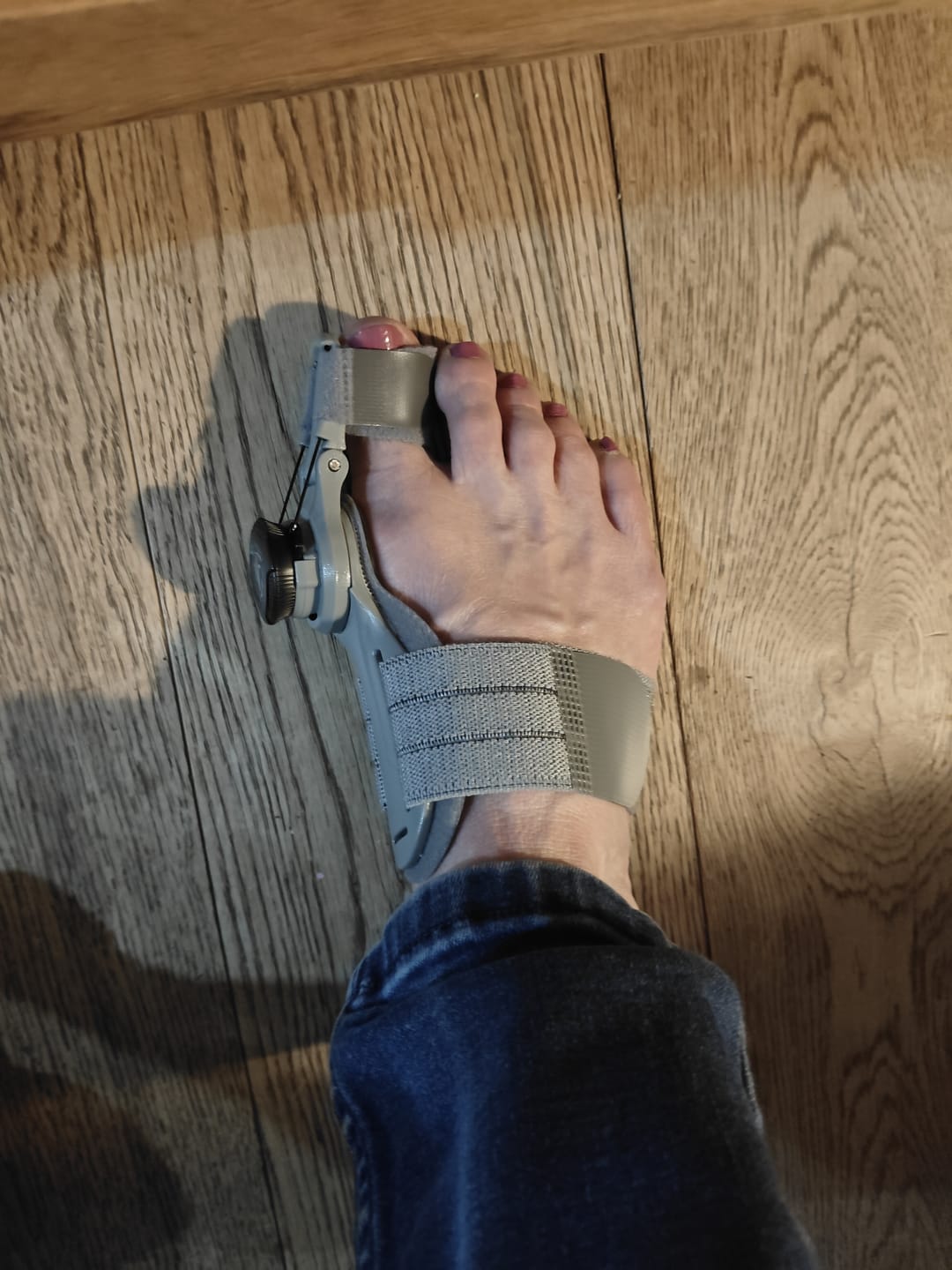 Customer photo review of Treatmedy™ Bunion Fix