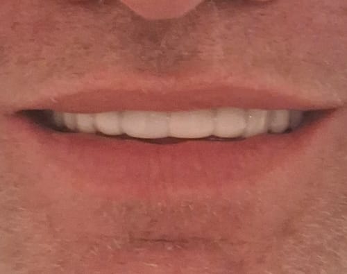 Customer photo review of Click-in Veneers 4.0
