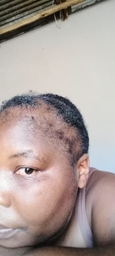 Customer photo review of Minoxidil 5% SOLUTION, 3 x 60ml pack