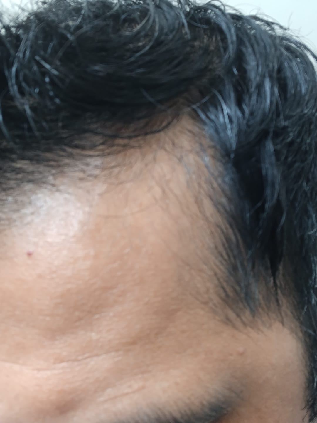 Customer photo review of Kit Adiós Alopecia | Detén la caída y Recupera el cabello.