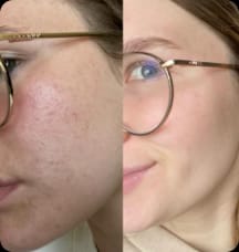 Customer photo review of Blinqo Chinology Sculpt V-Lift Mask