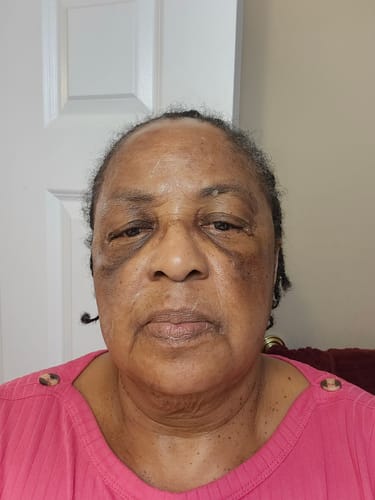 Reviewer showing their face before using Turmeric Fade & Glow Bar, with dark spots under the eyes and on cheeks.