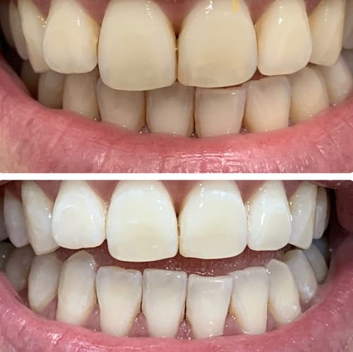 Customer photo review of Blanqueamiento Whiteness Perfect 22%