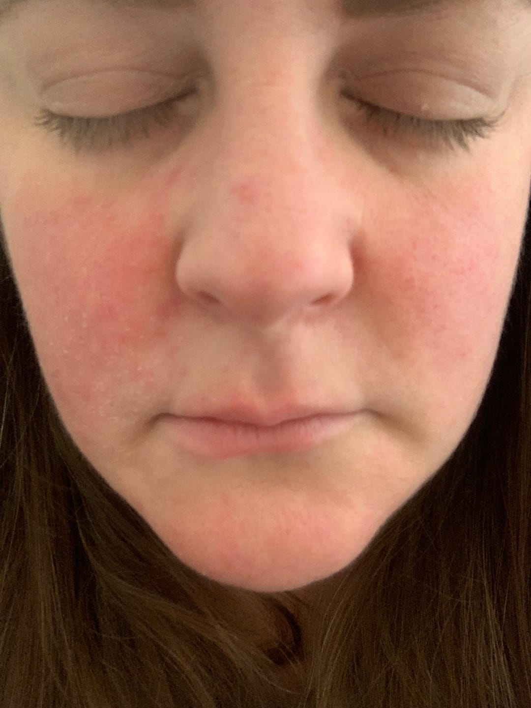 Customer photo review of Rosalique 3 in 1 Anti-Redness Miracle Formula SPF50