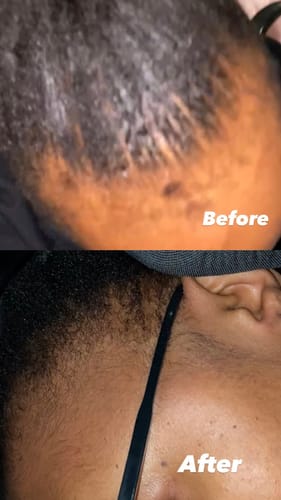 Customer photo review of Minoxidil 5% SOLUTION, 3x60ml pack
